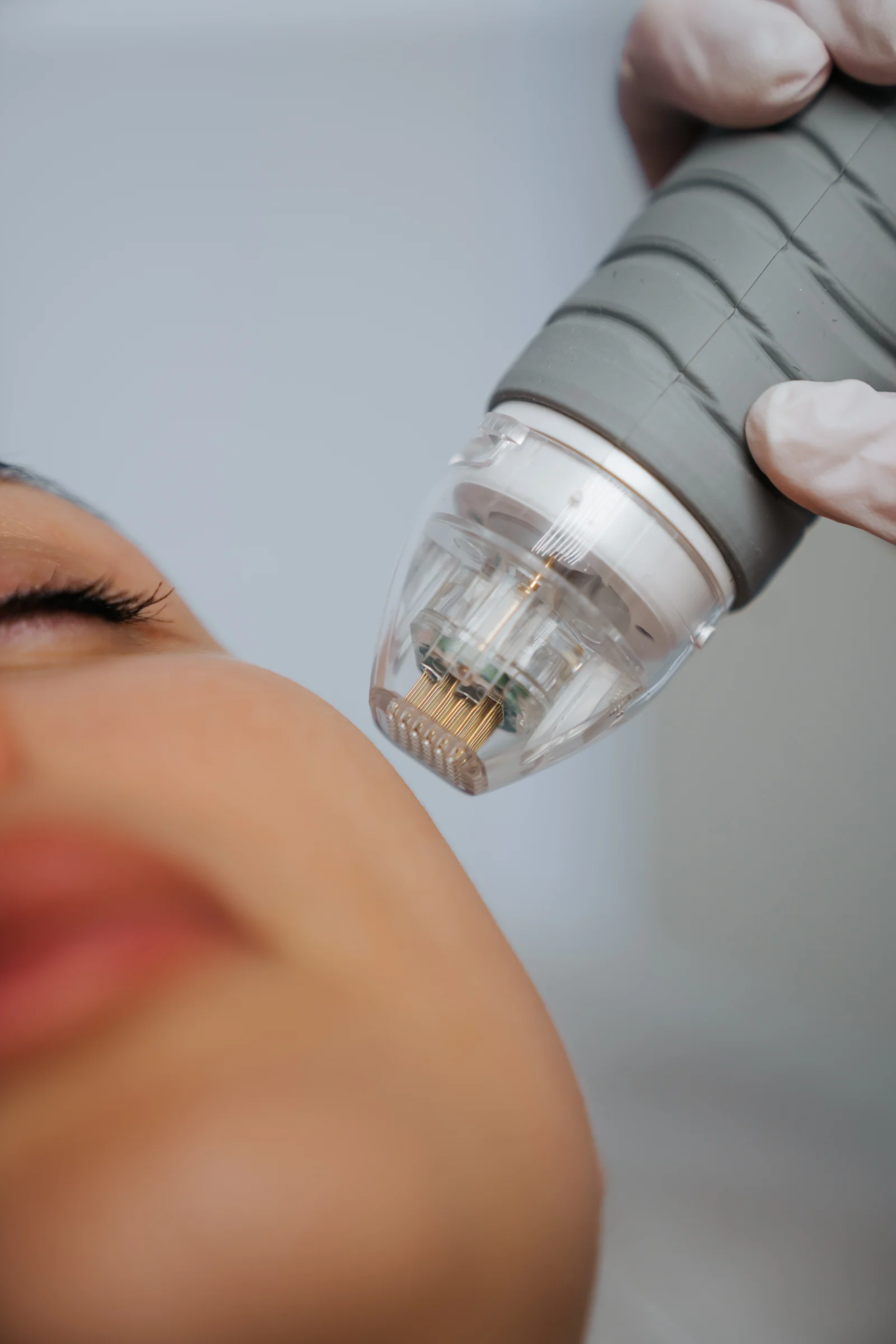 How Microneedling / MNRF Works