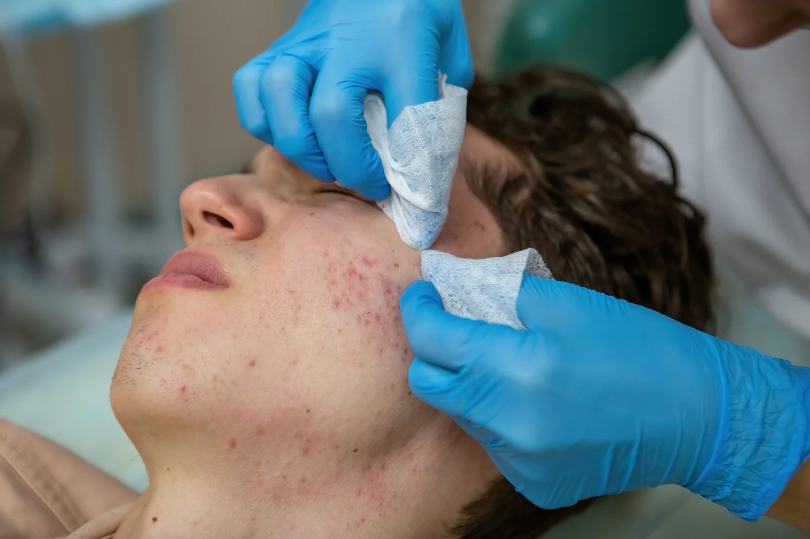 How Acne Scar Revision Works