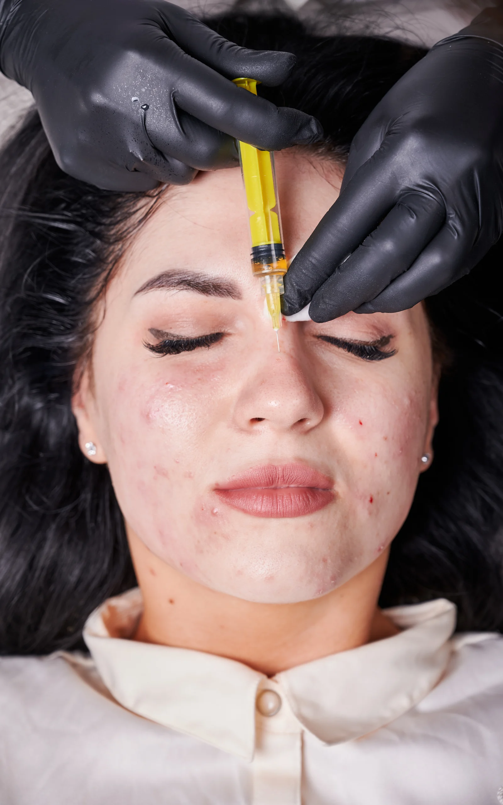 Acne Scar Revision for Smoother, Clearer & Even Skin